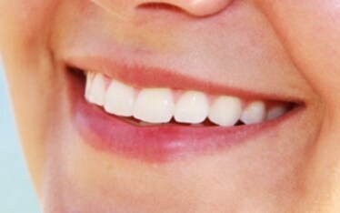 Denti bianchi con il cioccolato